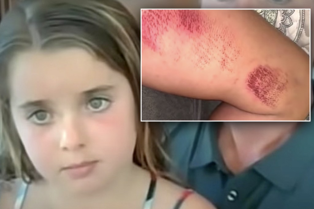 Photos show 6-year-old girl’s injuries after being dragged under Peloton&nbsp;treadmill