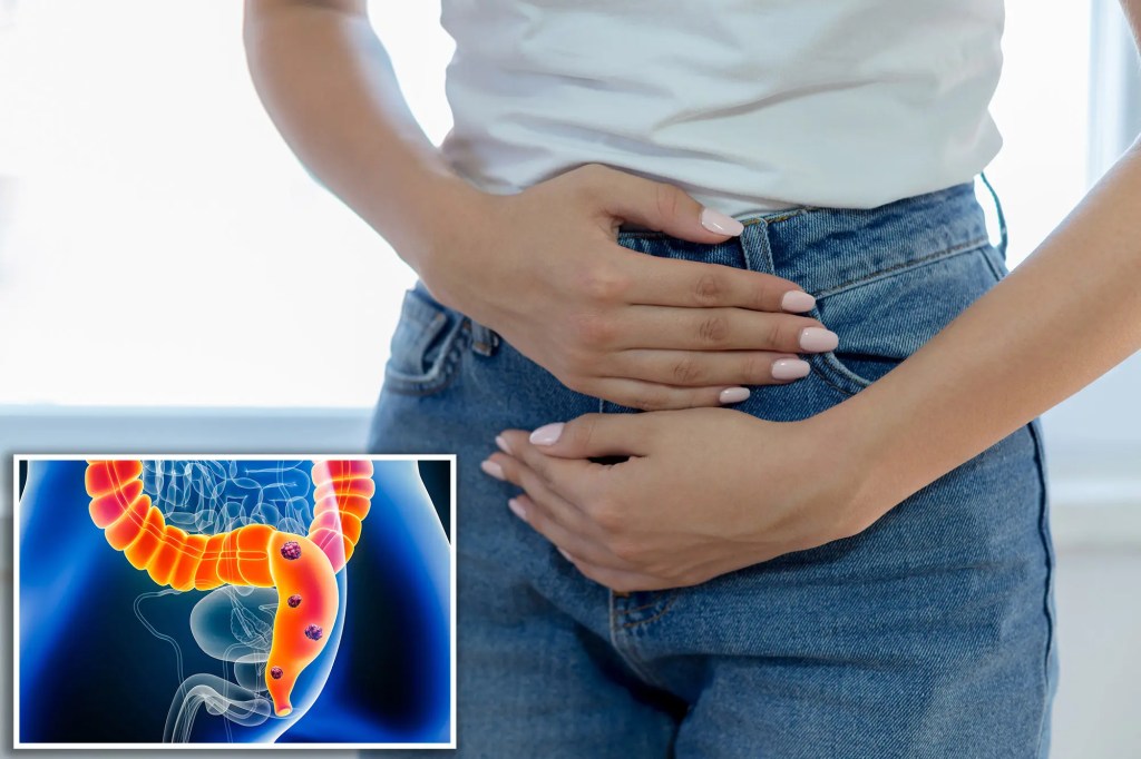 Colorectal cancer spike in young people could be caused by&nbsp;fungus